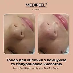 Тонер для обличчя Medi-Peel Hyal Kombucha Tea-Tox Toner з комбучею та гіалуроновою кислотою 150 мл - мініатюра 4