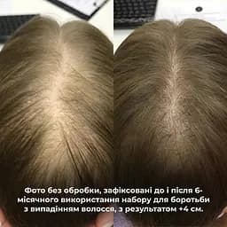 Маска Hillary Serenoa & РР Hair Loss Control проти випадіння волосся 200 мл - мініатюра 9
